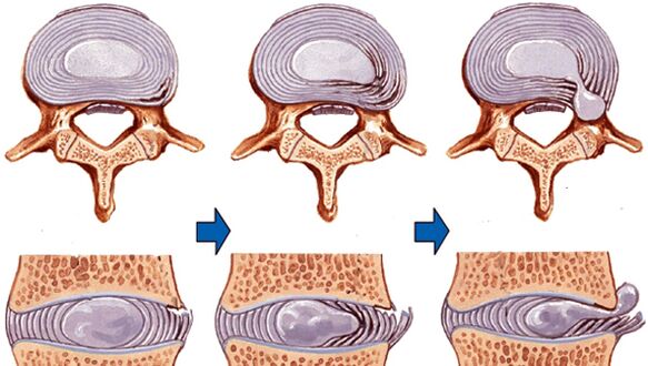 Danno spinale nell'osteocondrosi