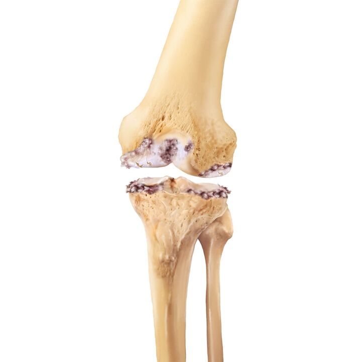 Distruzione dell'articolazione del ginocchio con artrosi