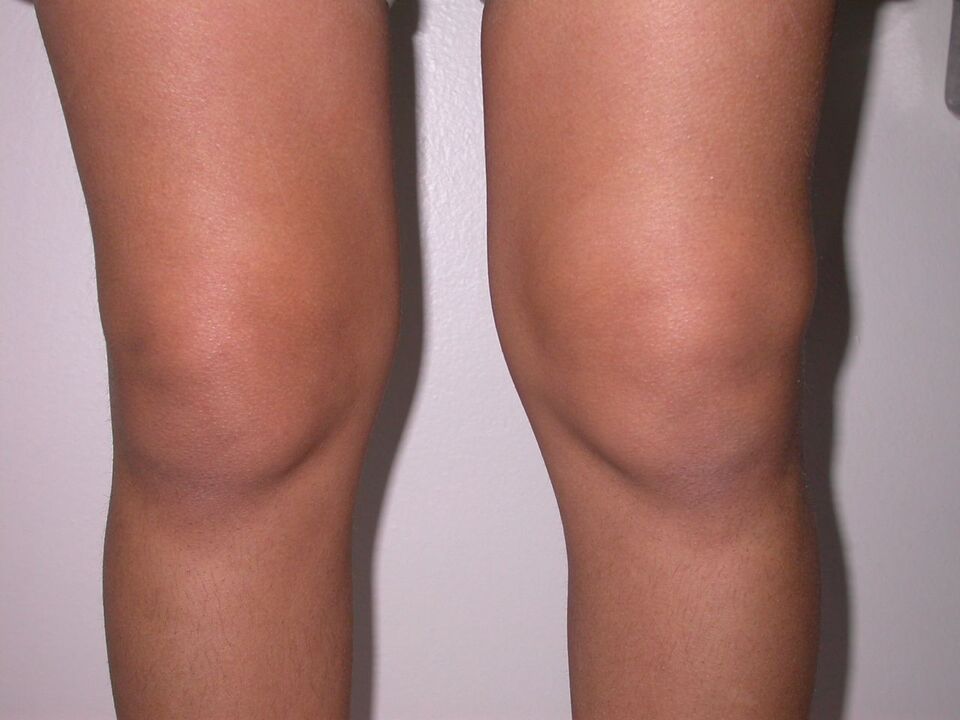 Gonfiore al ginocchio da osteoartrite