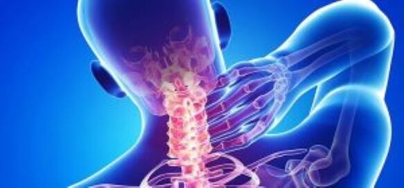 Osteocondrosi cervicale