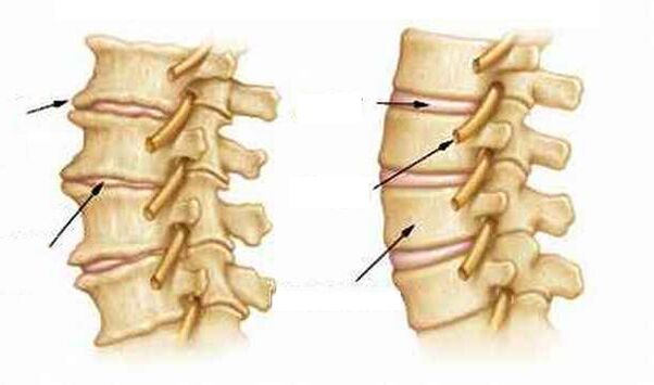Cos'è l'osteocondrosi