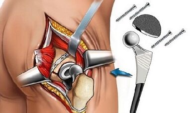 Endoprothetics for Hip Star Golats