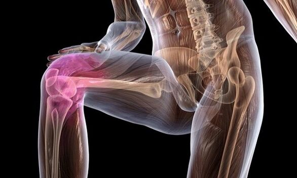 Segni e sintomi di osteoartrite dell'articolazione del ginocchio