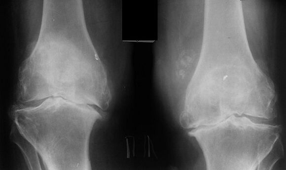 X -raggio come mezzo per diagnosticare l'artrosi dell'articolazione del ginocchio