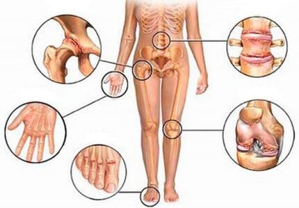 Artrite e osteoartrosi di articolazioni diverse
