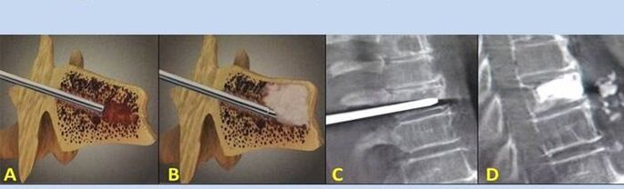 Vertebroplastica con puntura per il mal di schiena