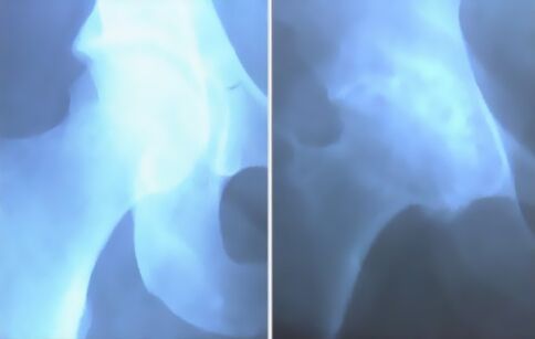 Immagine dell'osteoartrosi dell'articolazione del ginocchio