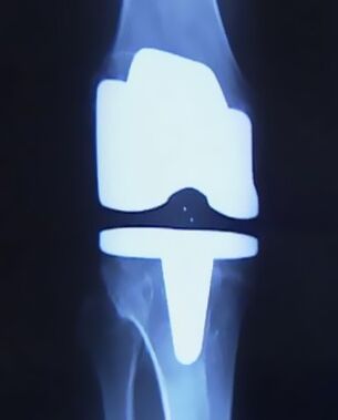 Radiografia di un ginocchio con una protesi artificiale dopo un intervento di sostituzione dell'articolazione