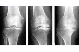 Fasi dell'osteoartrosi dell'articolazione su una radiografia