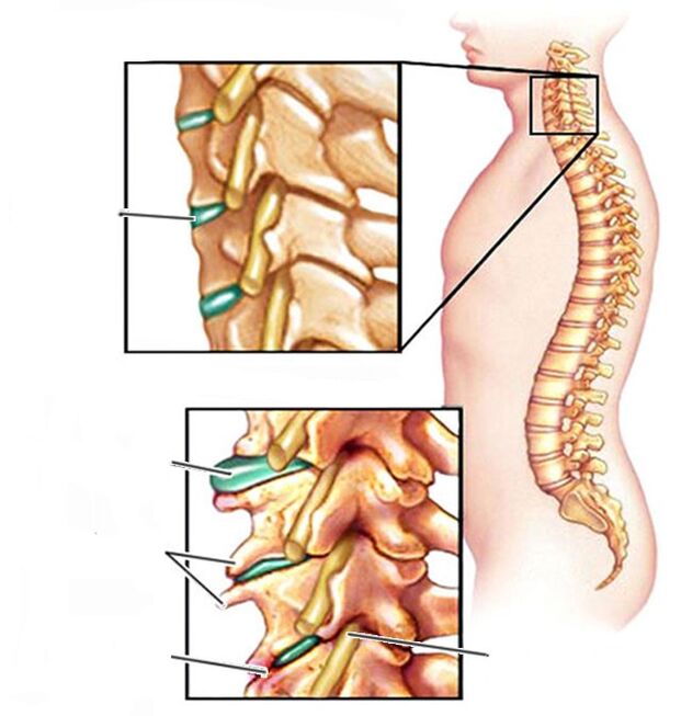 Osteocondrosi e colonna vertebrale cervicale sana