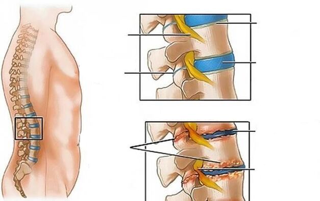 L'osteocondrosi della colonna lombare provoca mal di schiena