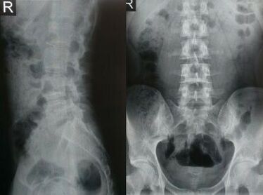 Radiografia della colonna lombare Lu